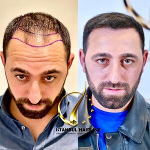 Istanbul Hairline _2