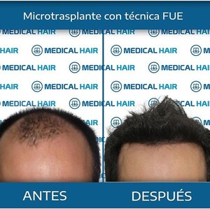 Medical Hair Spain _1