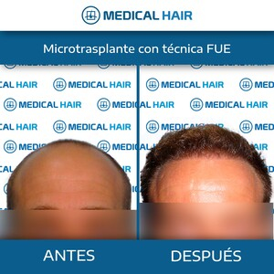 Medical Hair Spain _2