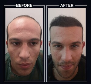 Clinista Hair Transplant Center _2