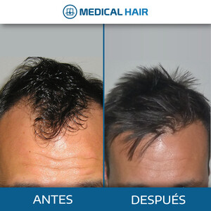 Medical Hair Spain _3