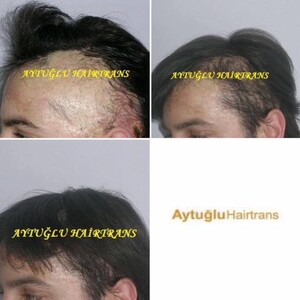 Aytuğlu Hairtrans _3