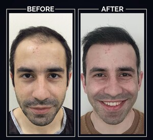 Clinista Hair Transplant Center _3