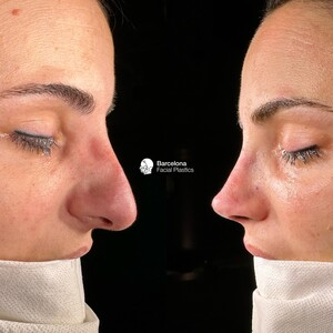 Barcelona Facial Plastics _3