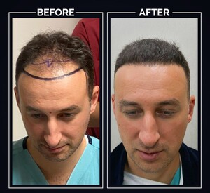 Clinista Hair Transplant Center _1