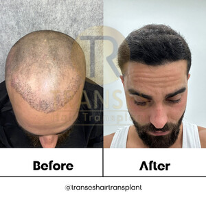 Transes Hair Transplant _0